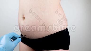 腹部成形术和背成形术：腹部<strong>吸脂</strong>和去除围裙。 在塑料浪涌接待处的病人